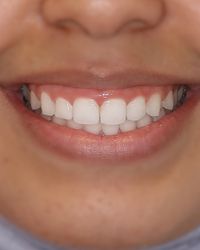 Gingivectomy Smile 1 before